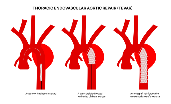 TEVAR procedure