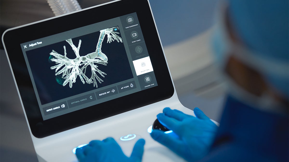 Ion Lung Cancer Screening Tech